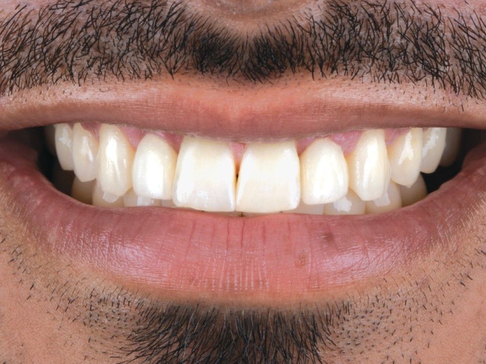 After: the same smile restored with dental implants